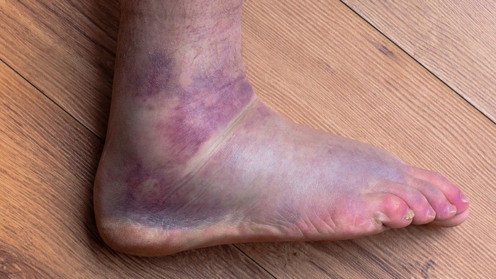 Worksheet featuring a lighthearted story about a twisted ankle with hidden similes for second graders